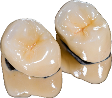 PFM Crown- Traditional tooth coloured crown