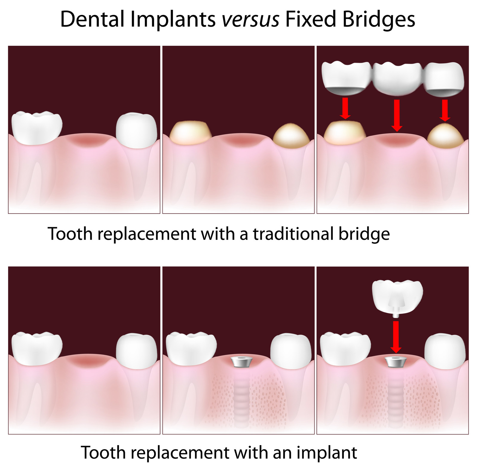 Fig 2. Implants Vs. Fixed Bridges