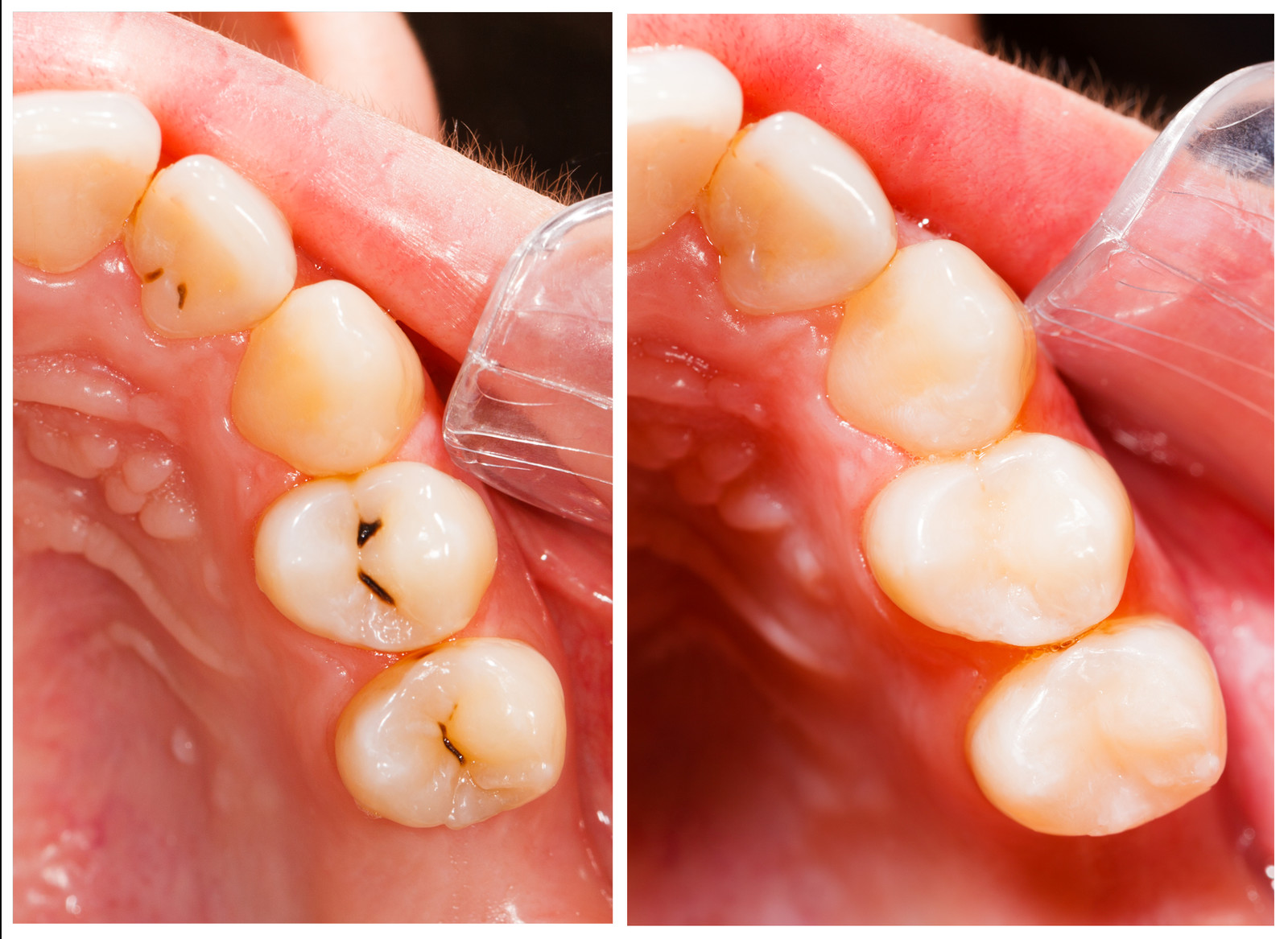Fig1. Small pit and fissure cavities restored in composite