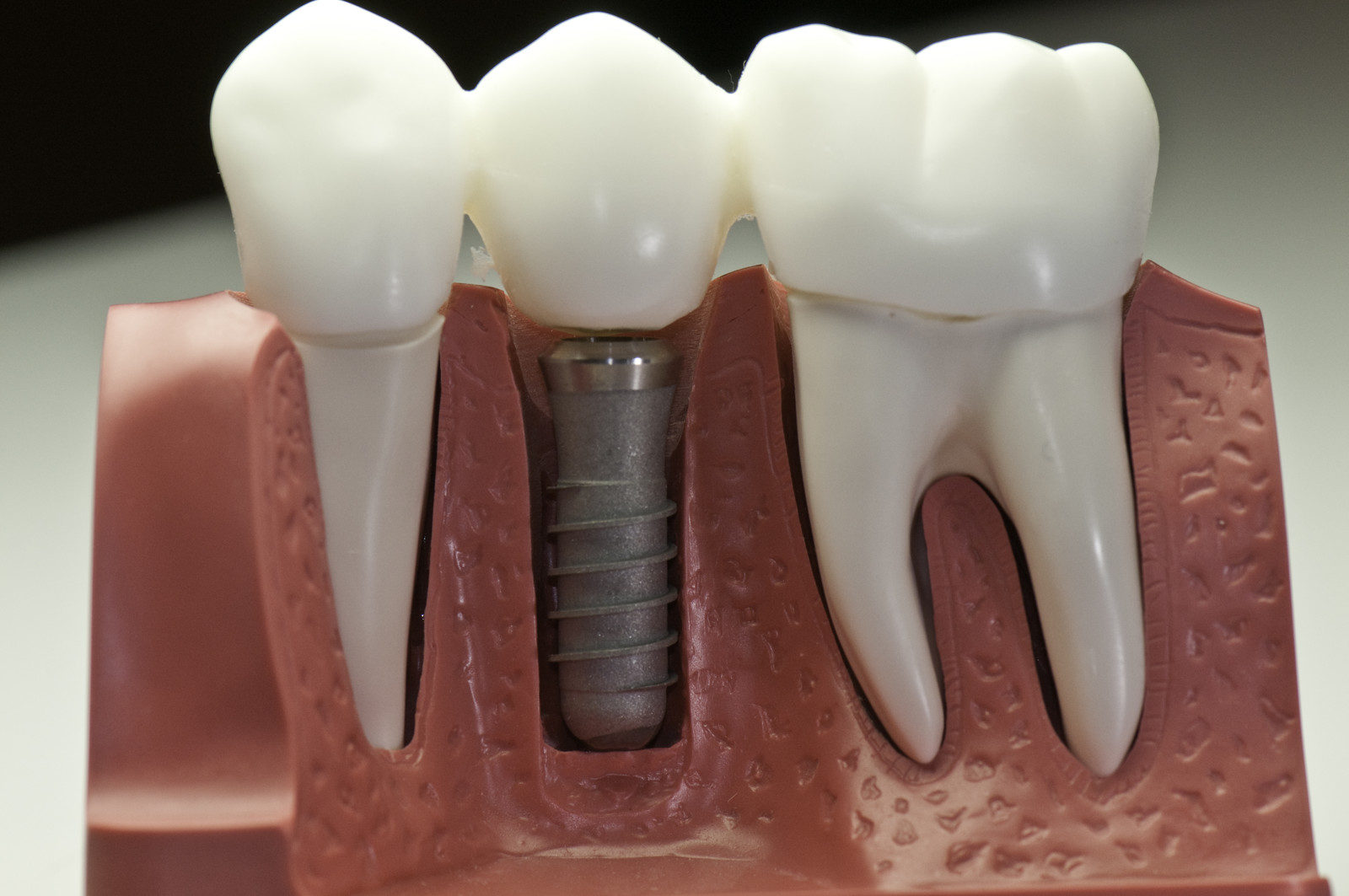 Fig 1: Implant Model 