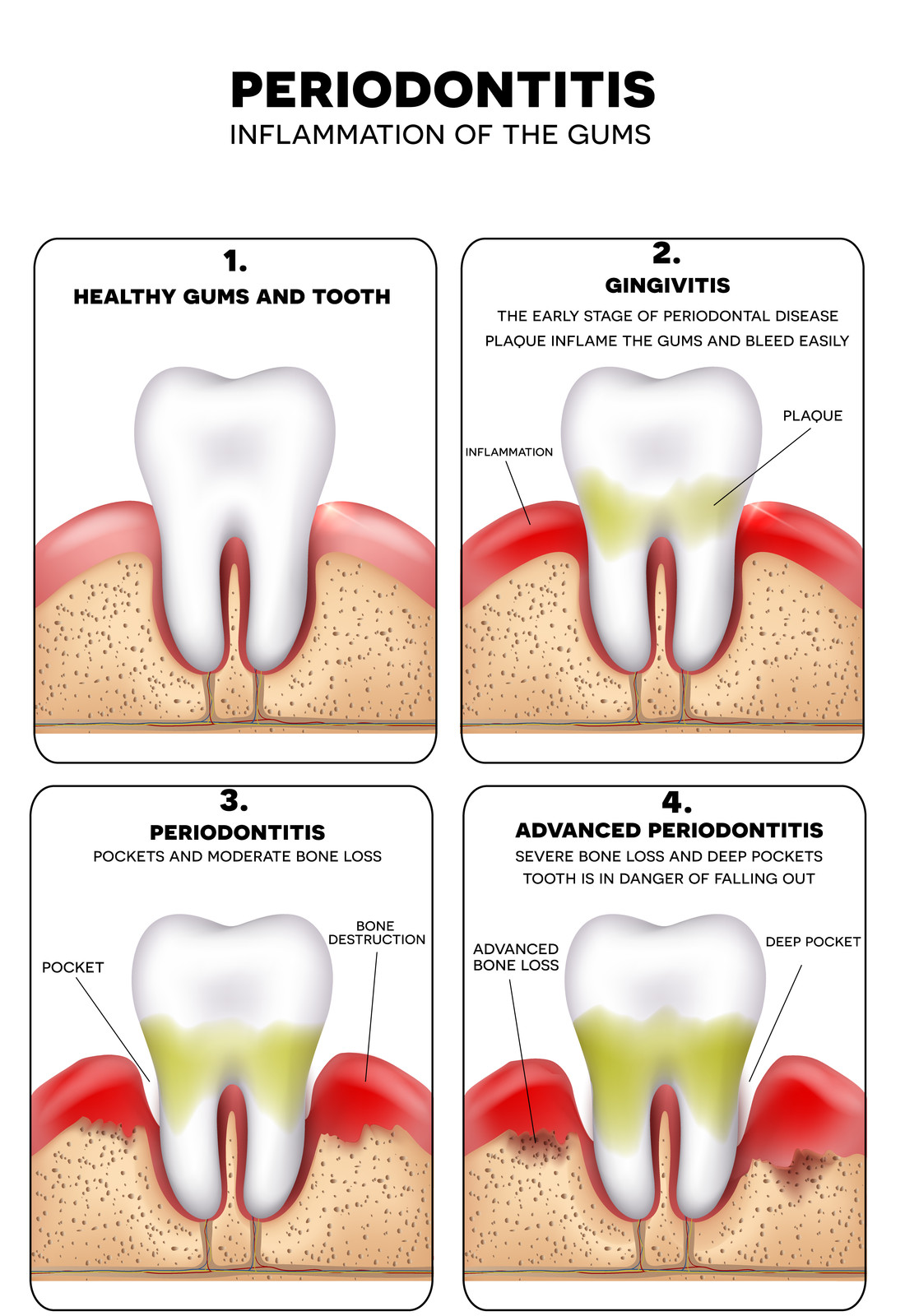 fig 1. Periodontal Disease Process