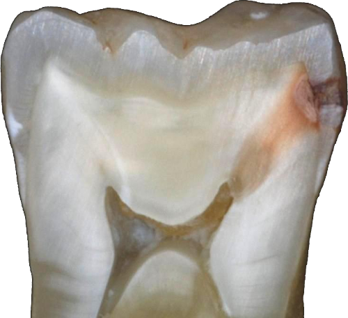 cavity2