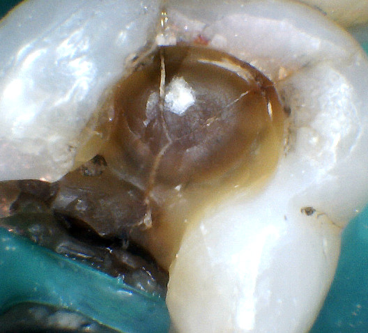 A crack has formed under a large filling, resulting in pain on biting.