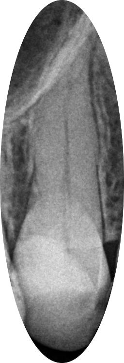 Before Root Canal