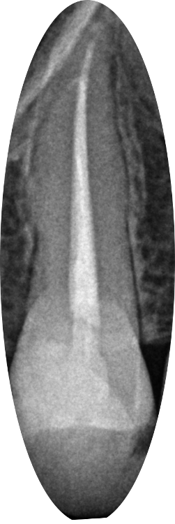Root Canal Completed