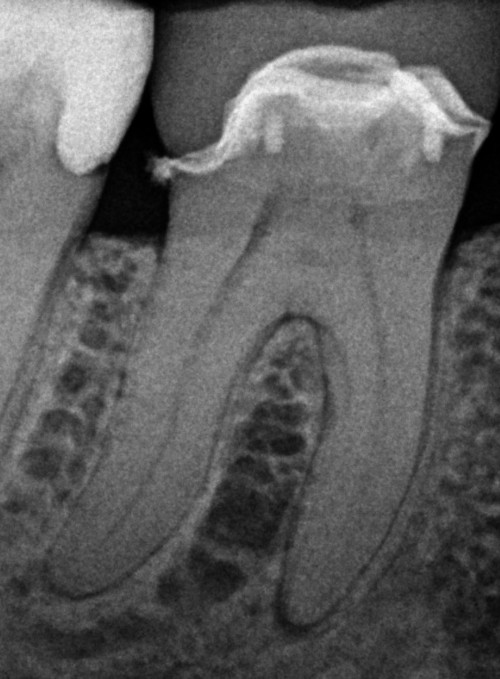 Chronic Periapical Periodontitis